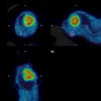 Microblastoma